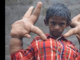 الطفل الهندي ذو الكف العملاق يترك الدراسة بعد أن أصبح كفاه أكبر من رأسه